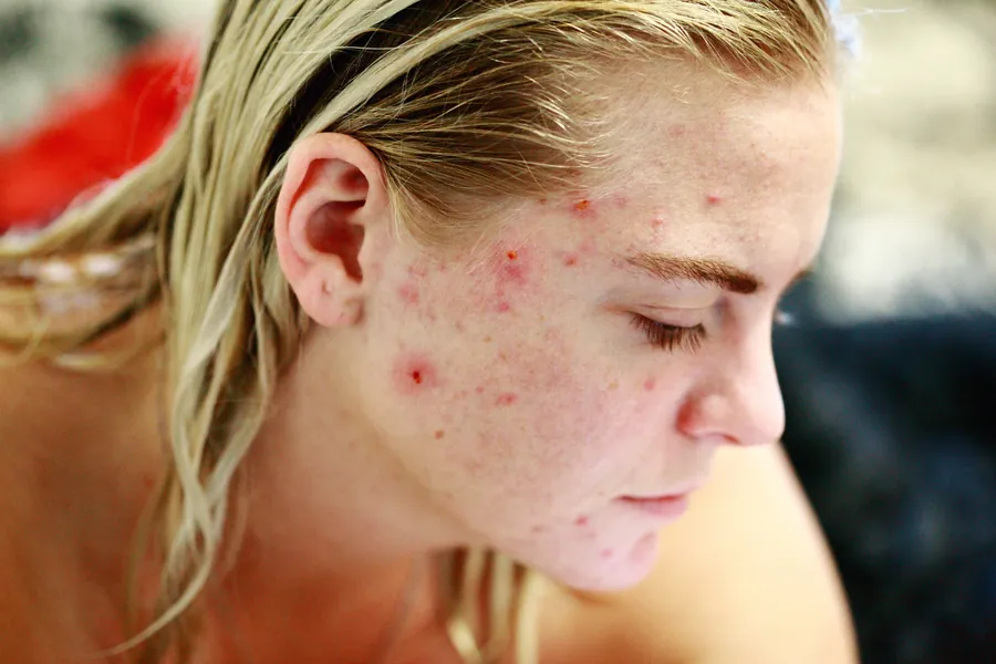 Personne se touchant le visage, représentant les problèmes de peau